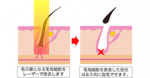 脱毛の効果が高い理由